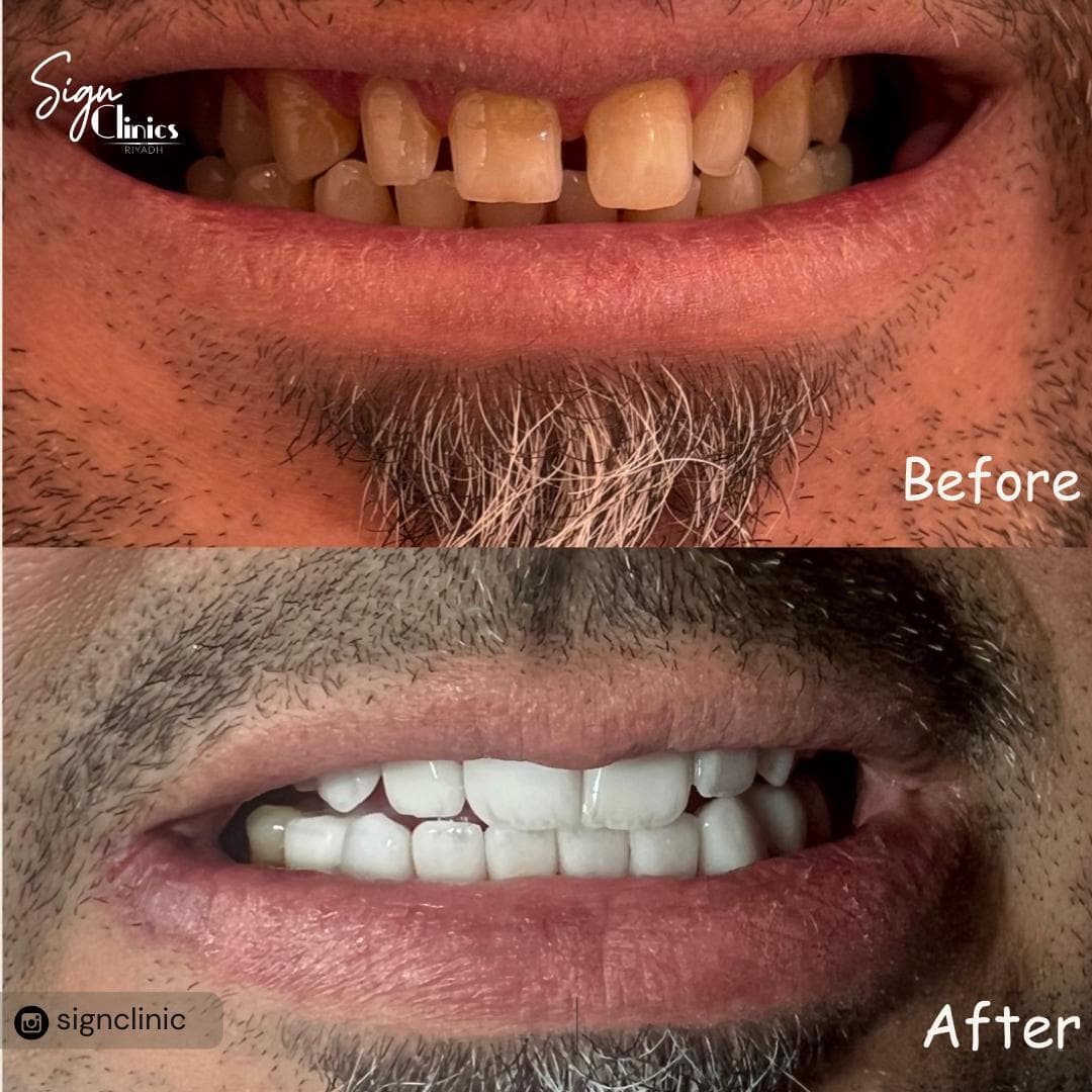 قبل وبعد - تحول كامل للابتسامة