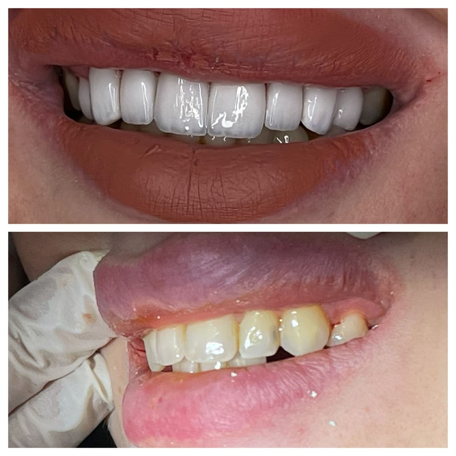 قبل وبعد - فينير