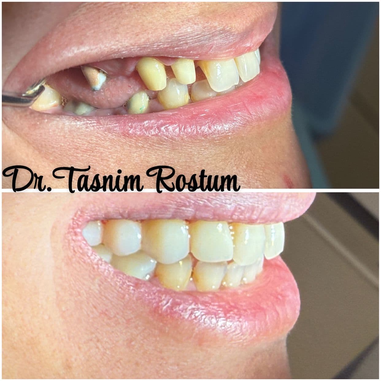 قبل وبعد - ترميم الأسنان
