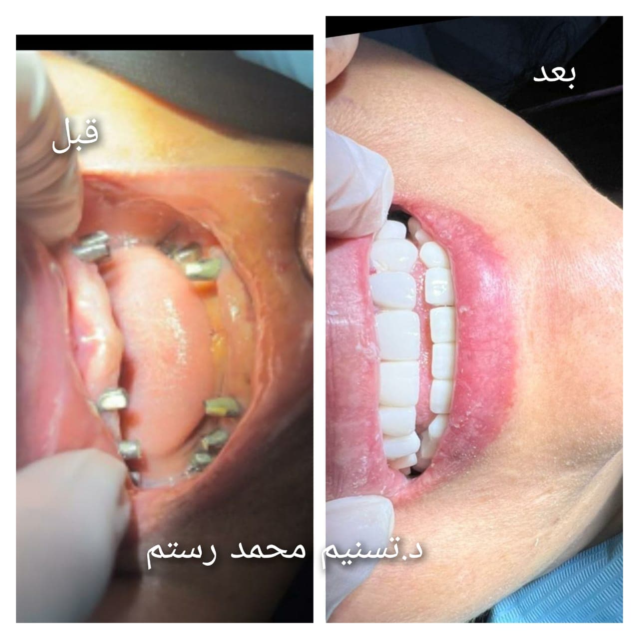 قبل وبعد - زراعة أسنان