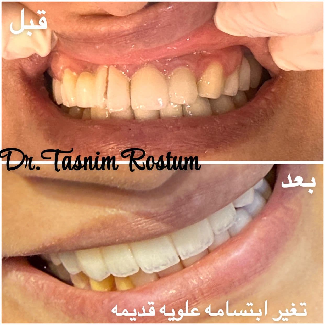 قبل وبعد - تغيير ابتسامة قديمة